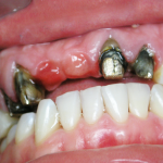 Опорные зубы после снятия старых металлокерамических коронок